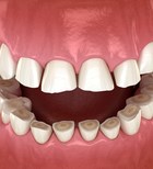 הנזקים האסתטיים של שחיקת שיניים-תמונה